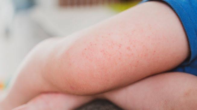 Wabah Baru Flu Tomat, Serang Anak- Anak Belum Ada Obatnya